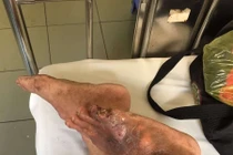 Bệnh gút cẩn thận hạt tophi lở loét gây tàn phế