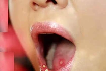 Bài thuốc trị nhiệt miệng