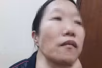 Mổ thành công bệnh nhân u tuyến giáp khổng lồ gây chít hẹp khí quản