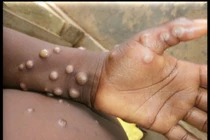 Bệnh đậu mùa khỉ lan ra 30 nước với hơn 1600 ca