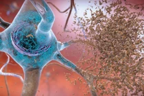 Phương pháp mới chế tạo văcxin và điều trị bệnh Alzheimer