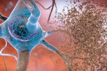 Phương pháp mới chế tạo văcxin và điều trị bệnh Alzheimer