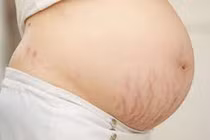 Rạn da khi mang thai không chữa được