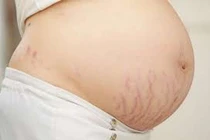 Rạn da khi mang thai không chữa được