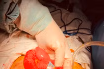 Thủng ruột vì uống thuốc nguyên vỏ