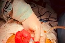 Thủng ruột vì uống thuốc nguyên vỏ