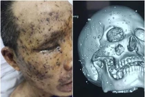 Phẫu thuật thành công nạn nhân bị trăm mảnh kim loại găm vào mặt