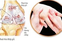 6 biện pháp phòng, chữa đau cơ xương khớp trời lạnh