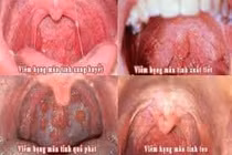 Ngủ thở miệng và viêm họng teo