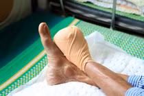 Cứu bàn chân ở bệnh nhân đái tháo đường 