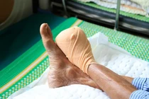 Cứu bàn chân ở bệnh nhân đái tháo đường 