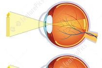 Chỉnh kính để tật khúc xạ không gây nhược thị vĩnh viễn ở trẻ