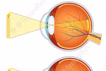 Chỉnh kính để tật khúc xạ không gây nhược thị vĩnh viễn ở trẻ