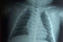 Chiếc nhẫn trong ngực bé gái trước khi được gắp ra ngoài