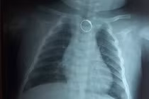 Chiếc nhẫn trong ngực bé gái trước khi được gắp ra ngoài