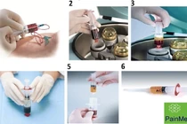 Huyết tương giàu tiểu cầu điều trị thoái hóa khớp gối