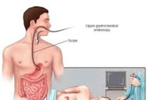 Xuất huyết tiêu hóa do vỡ tĩnh mạch thực quản