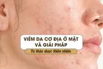 Viêm da cơ địa ở mặt và giải pháp từ thảo dược thiên nhiên