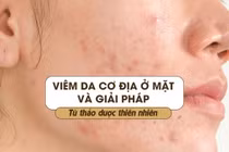 Viêm da cơ địa ở mặt và giải pháp từ thảo dược thiên nhiên