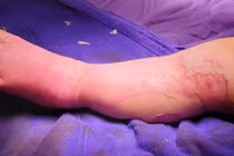 Bé 9 tháng tuổi tử vong vì đắp lá chữa bỏng