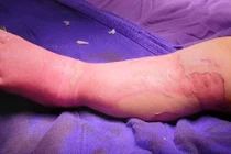 Bé 9 tháng tuổi tử vong vì đắp lá chữa bỏng