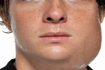 Quai bị và nguy cơ ung thư nên biết để phòng tránh