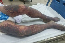 Tử vong do ăn thịt lợn chết