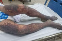 Tử vong do ăn thịt lợn chết