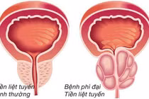 Tăng sản lành tính tuyến tiền liệt 