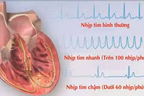 Nhịp tim xoang nhanh do mỡ máu