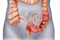 Tắc ruột do yếu tố thần kinh 