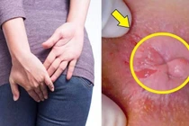 Hỏng hậu môn vì tự đi tiêm trĩ
