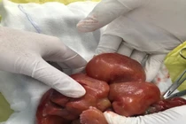 Phẫu thuật thành công lấy khối u trong bụng bé sơ sinh 1 ngày tuổi