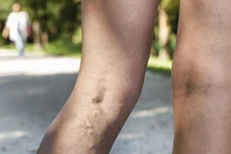 Chích xơ điều trị giãn tĩnh mạch