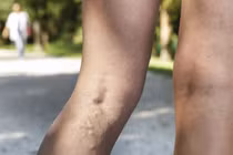 Chích xơ điều trị giãn tĩnh mạch