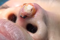 Xử lý biến chứng lộ sóng mũi dễ hay khó?