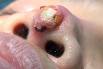 Xử lý biến chứng lộ sóng mũi dễ hay khó?