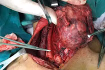 Để lâu u giáp tái phát xâm lấn nhiều nơi.