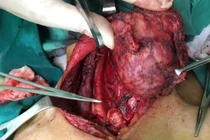 Để lâu u giáp tái phát xâm lấn nhiều nơi.