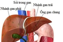 Hy hữu: Sỏi túi mật tái phát sau khi đã cắt túi mật