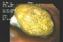 Bã thức ăn gây xuất huyết tiêu hóa