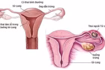 Vì sao thai ngoài tử cung vỡ lại gây nguy hiểm?