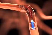 Hút huyết khối bằng dụng cụ cơ học 