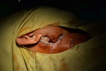 Hãi hùng loét hoại tử từ tai đến ngực do đái tháo đường