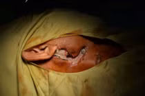 Hãi hùng loét hoại tử từ tai đến ngực do đái tháo đường