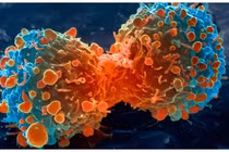 Ăn nhiều mỡ dễ bị ung thư