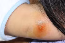 Nhiễm khuẩn huyết vì vết gai đâm