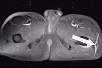 Tổn thương Morel Lavalleé