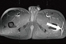 Tổn thương Morel Lavalleé