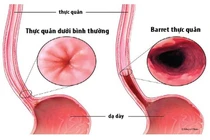 Barret thực quản có tự khỏi được không?